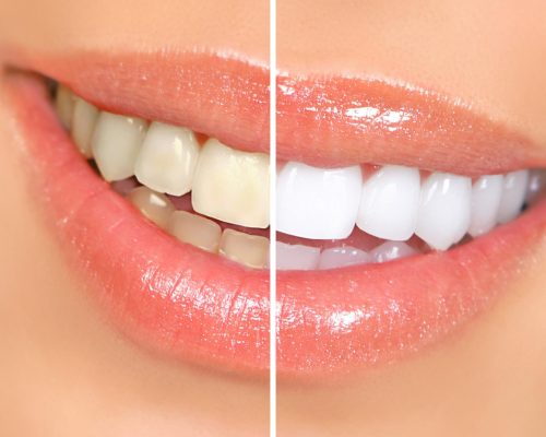 clareamento dental