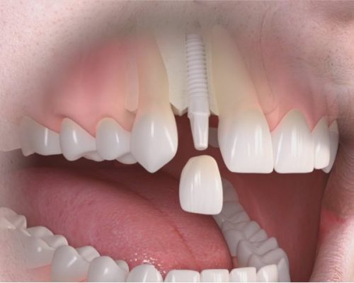 implante dental