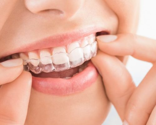 invisalign alinhadores