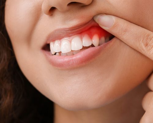 tratamento periodontal